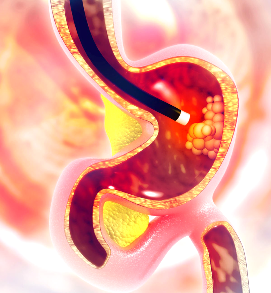 Endoscopia Normal Exames - Excelência Diagnósticos